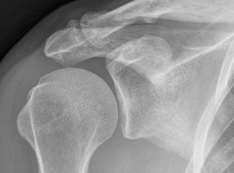 ACJ OA Inferior Clavicle Osteophyte